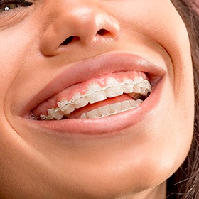 thumb-treatment-braces-ceramic