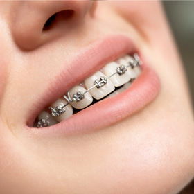 thumb-treatment-braces-metal
